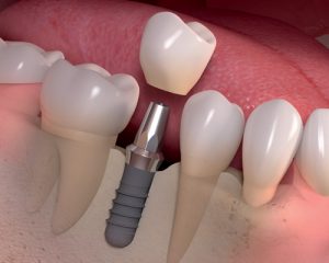 Dental Implant, Tooth Implant