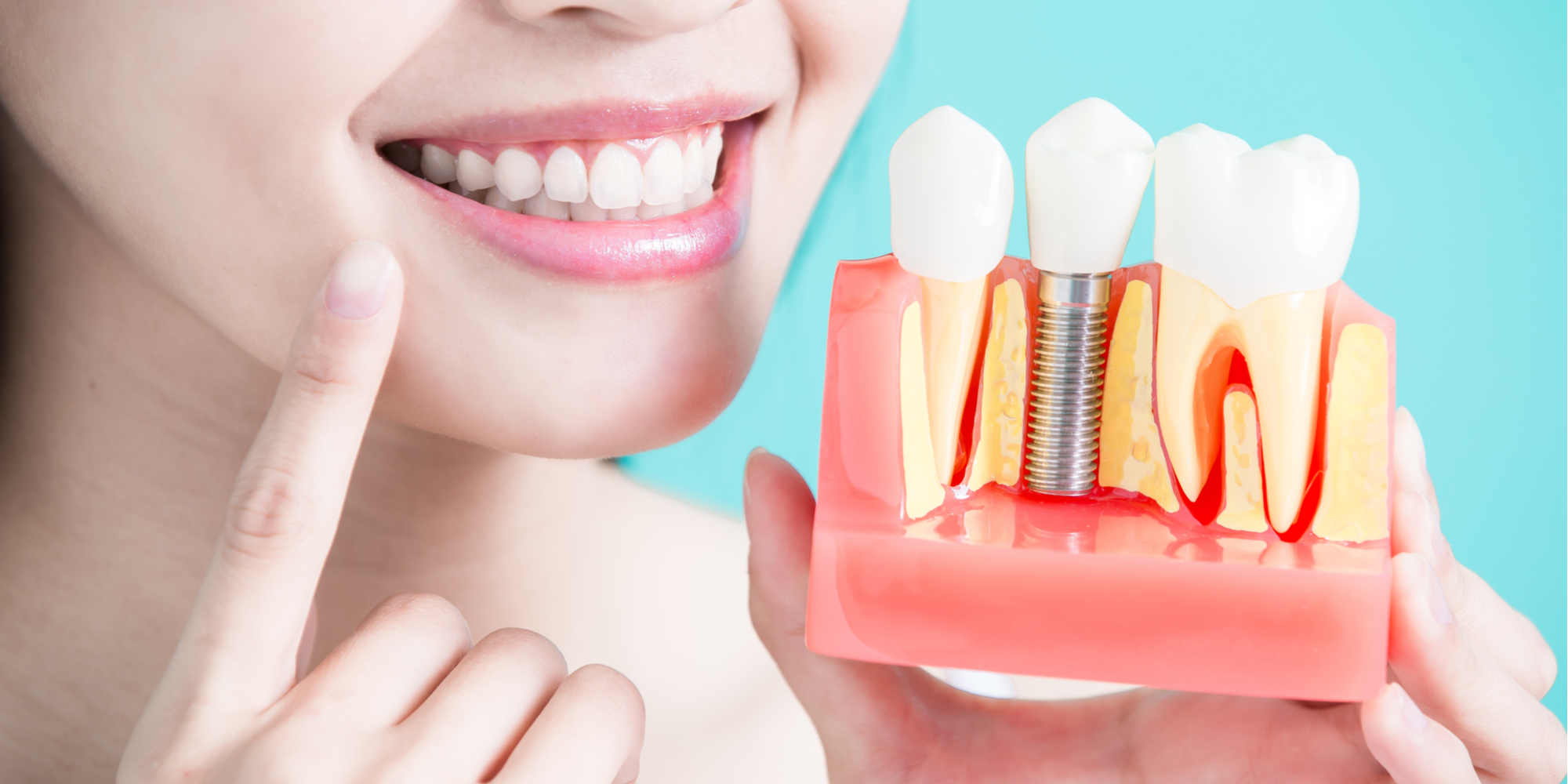 What are Dental Implants and How Can They Better Your Smile?