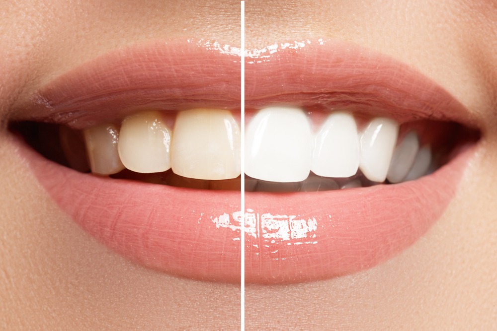 How Long Does Teeth Whitening Take