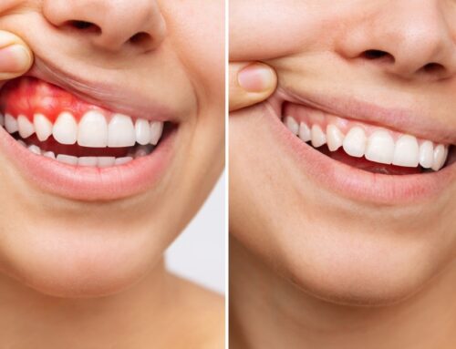 Gum Care Month: Preventing Gingivitis and Gum Disease