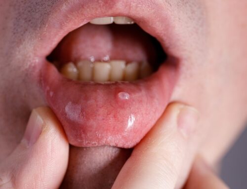 Oral Cancer Month: Symptoms to Watch Out For